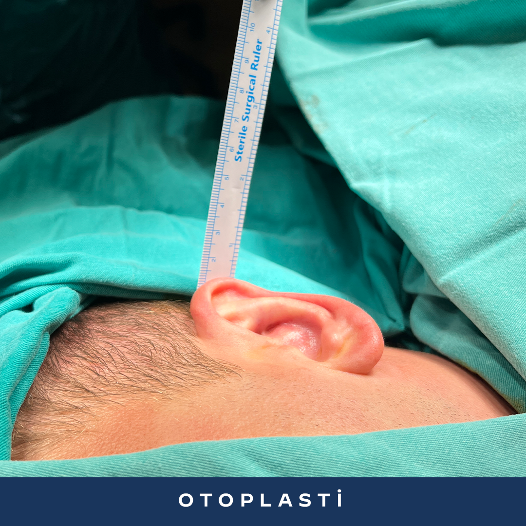İK23-1-Otoplasti