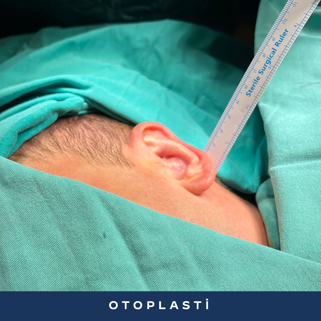 İK23-2-Otoplasti