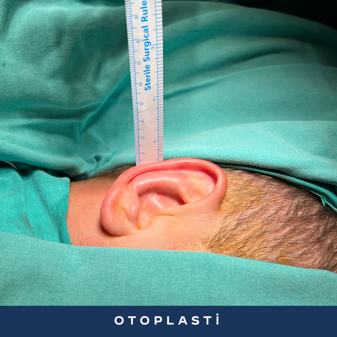 İK23-3-Otoplasti
