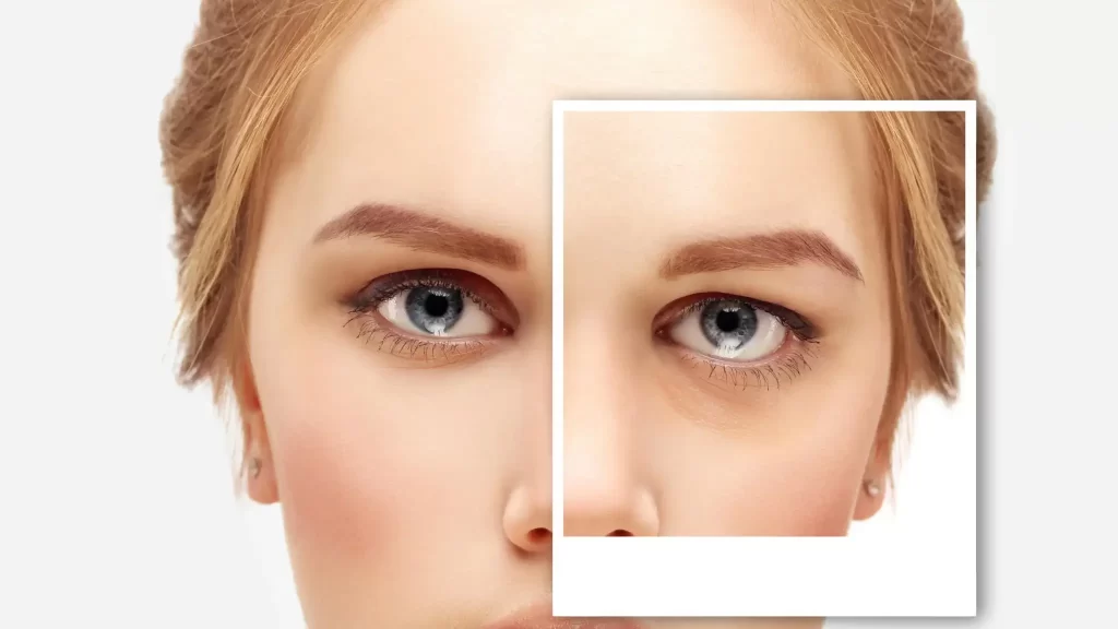 blepharoplasty