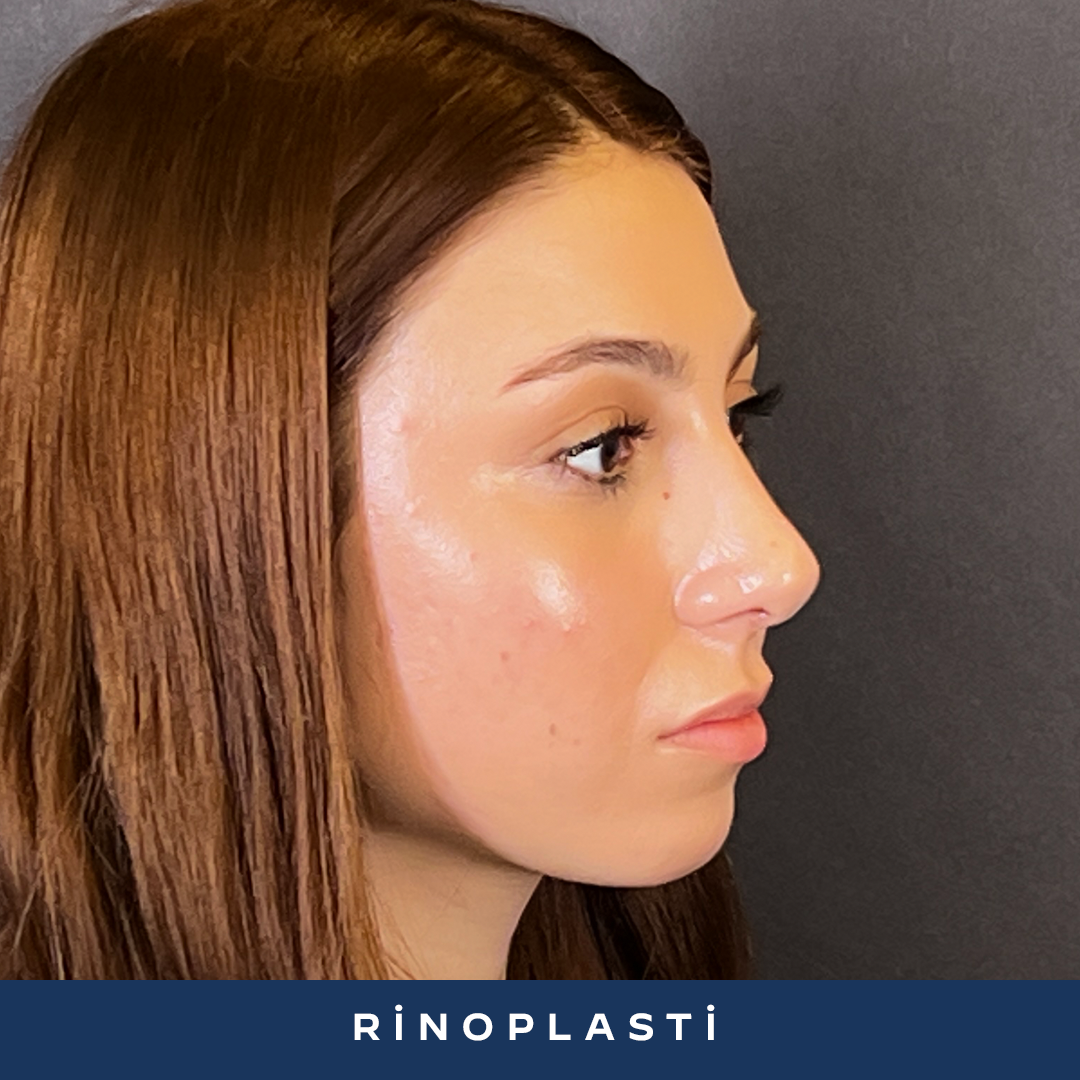 İK23-2-Rinoplasti