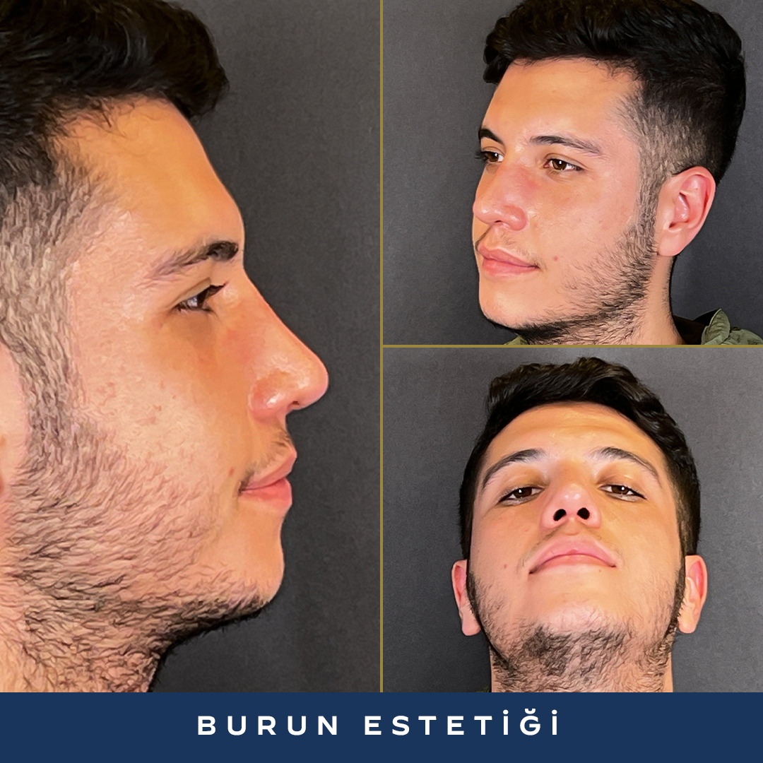 İK23-Rinoplasti-After